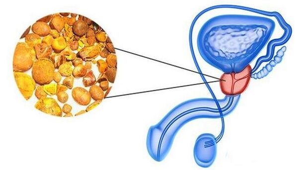 Calculează în glanda prostatei