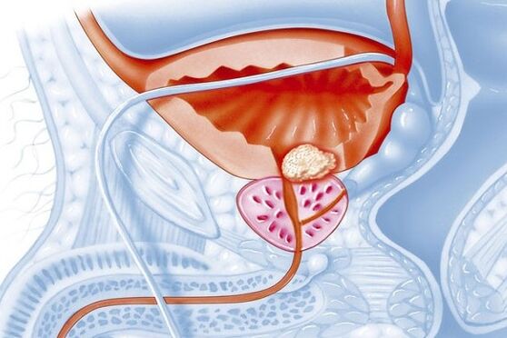 Proces inflamator la nivelul prostatei
