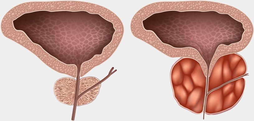 prostată sănătoasă și inflamată cu prostatita