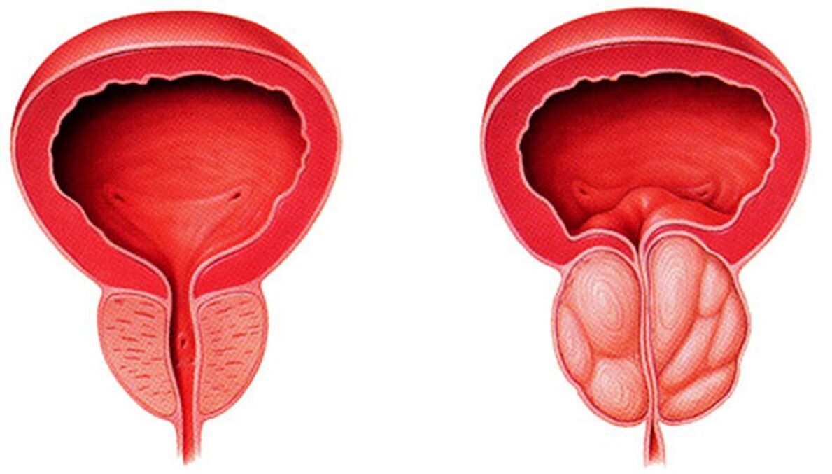 prostată sănătoasă și inflamată cu prostatita