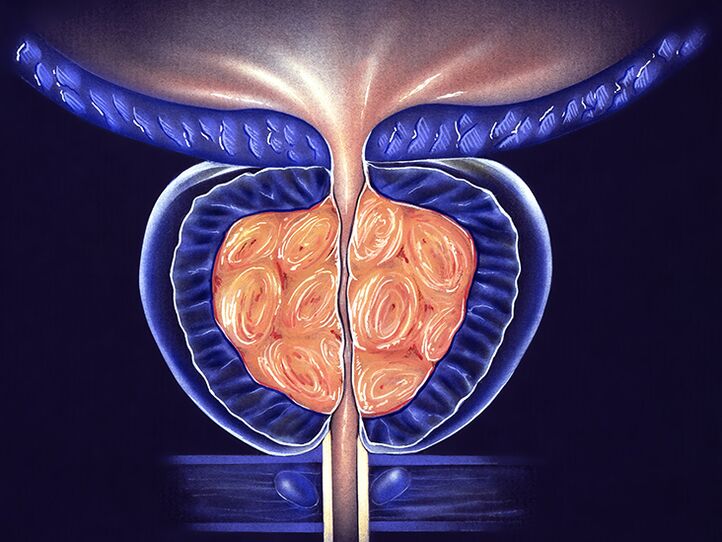 prostată inflamată și prevenirea prostatitei